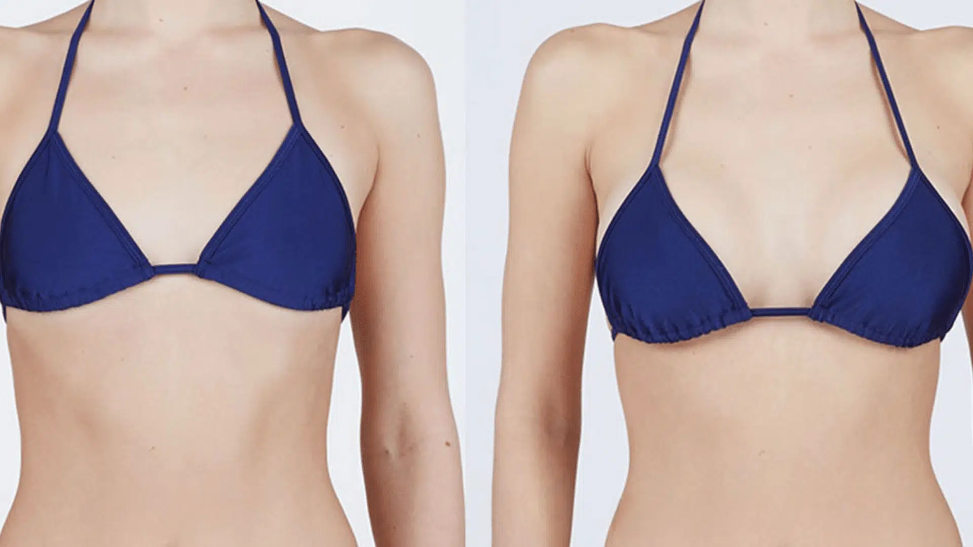 Breast-Augmentation-and-Lift