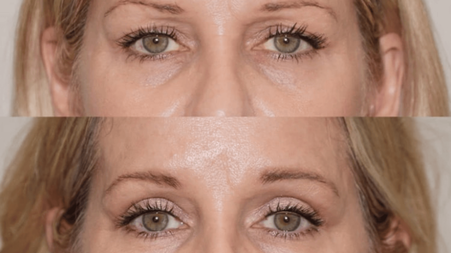 Eyelid-Surgery-(Blepharoplasty) (2)