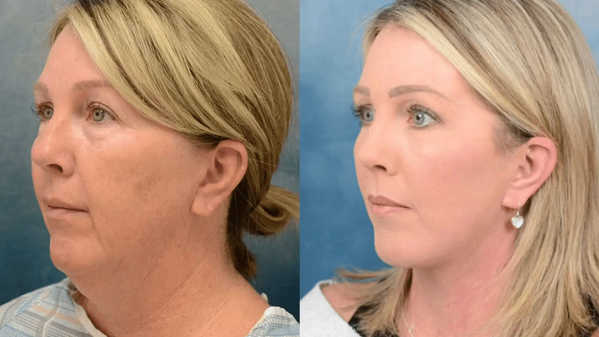 Facelift (1)