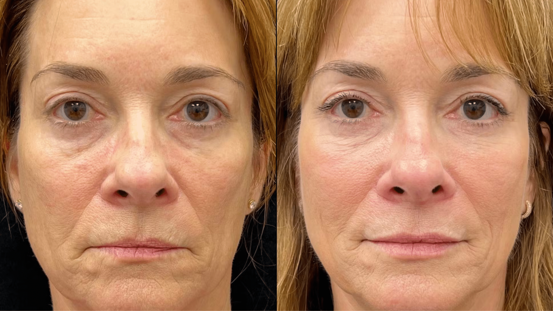 Fillers and Injectables