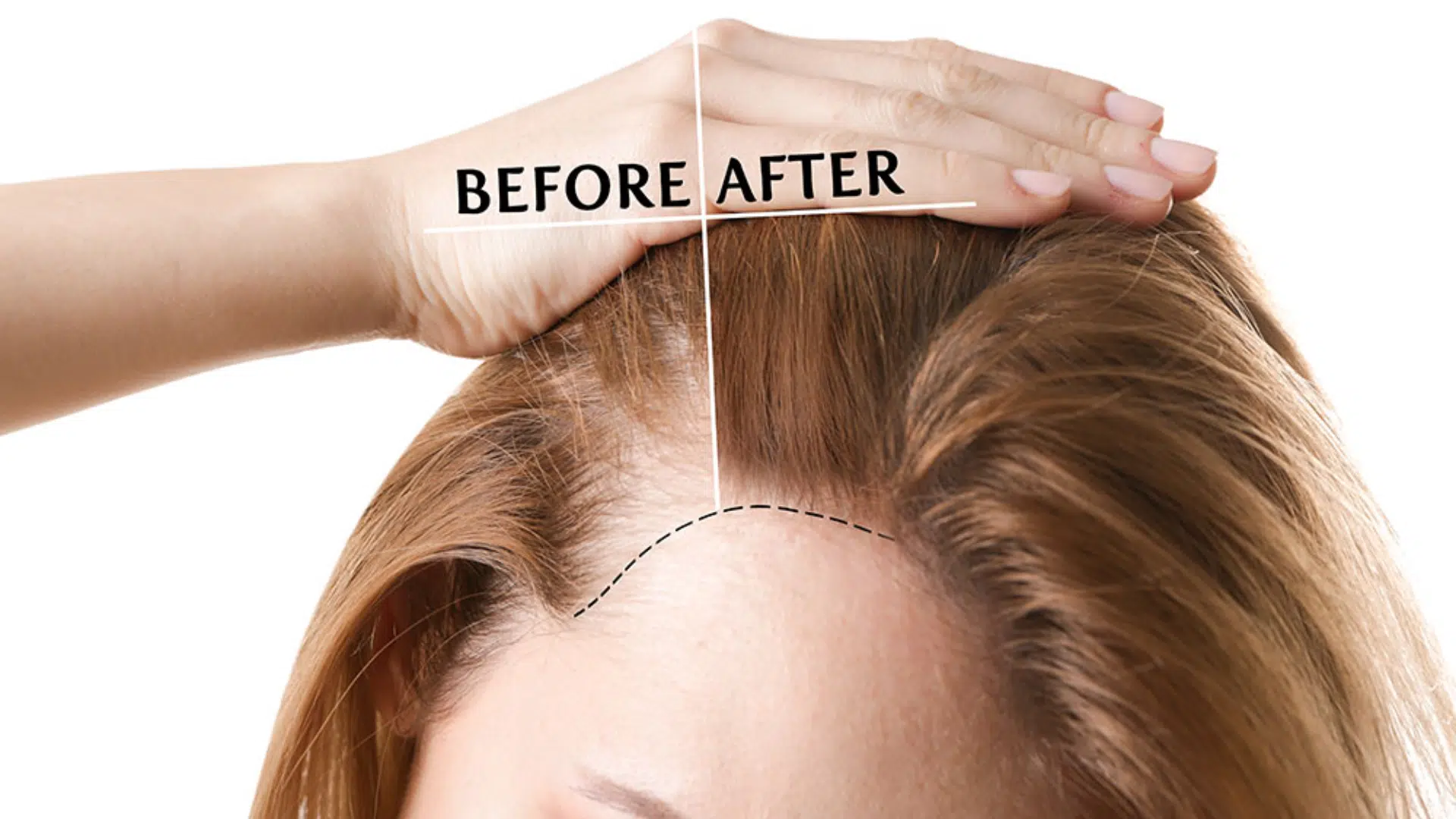 Hair Transplant