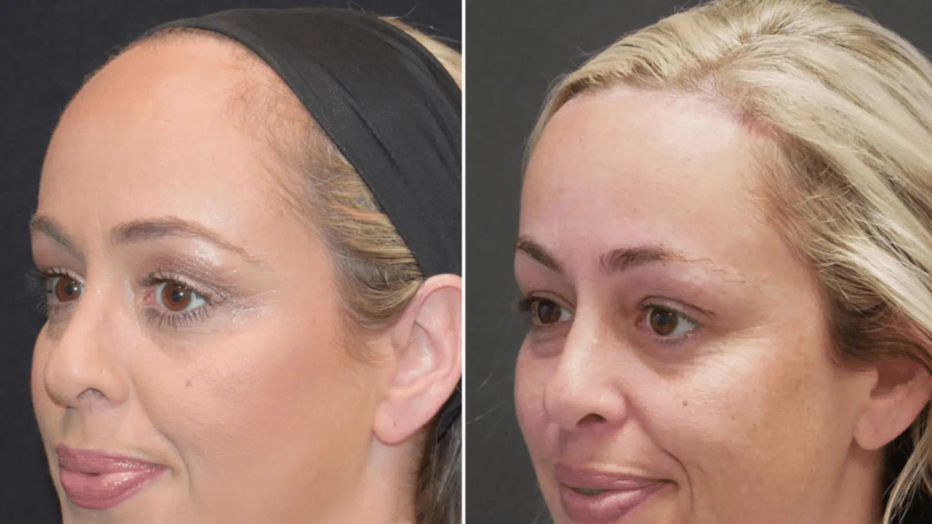 Hairline Surgery