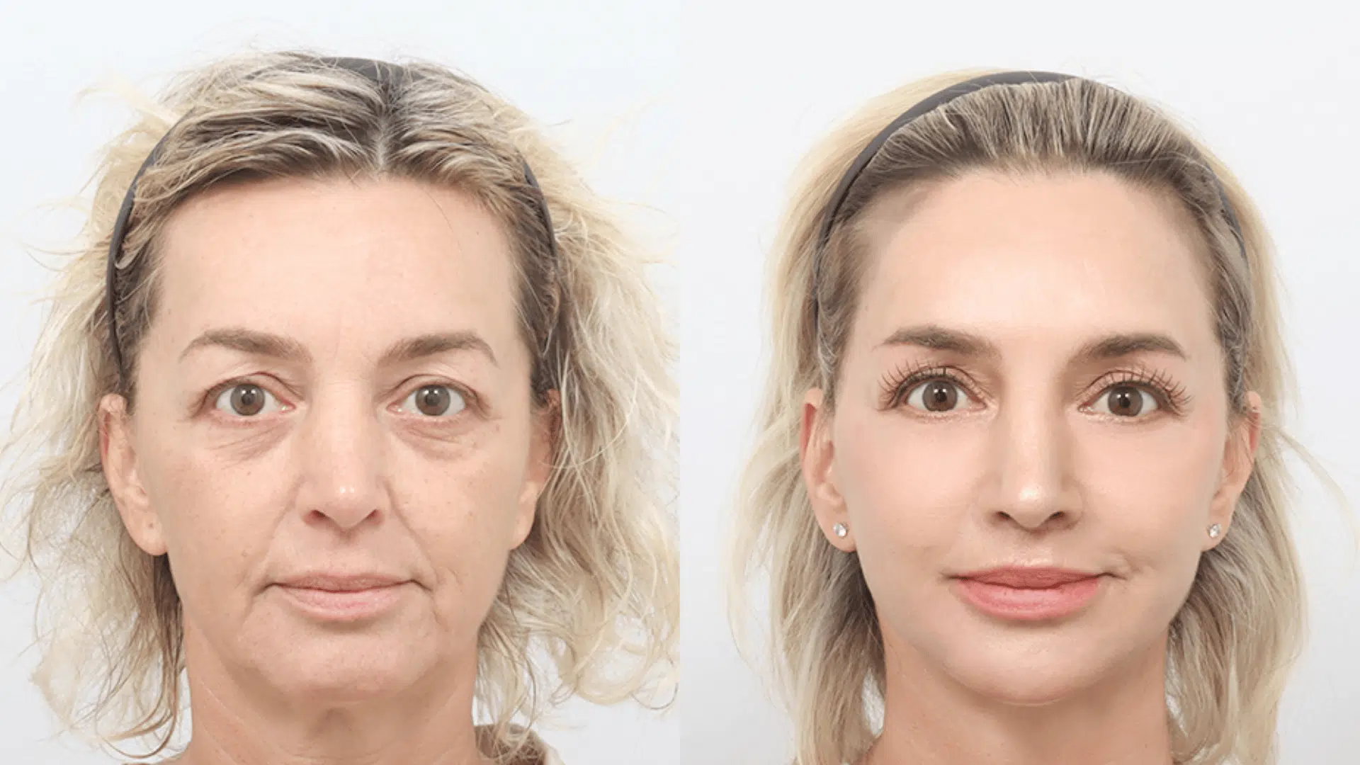 How-to-Evaluate-Before-and-After-Plastic-Surgery-Results