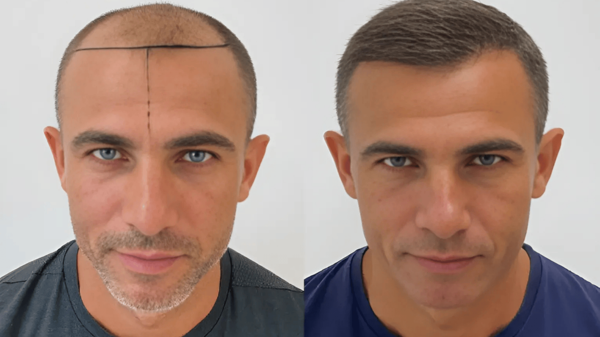 Key Factors That Affect Hair Transplant Results