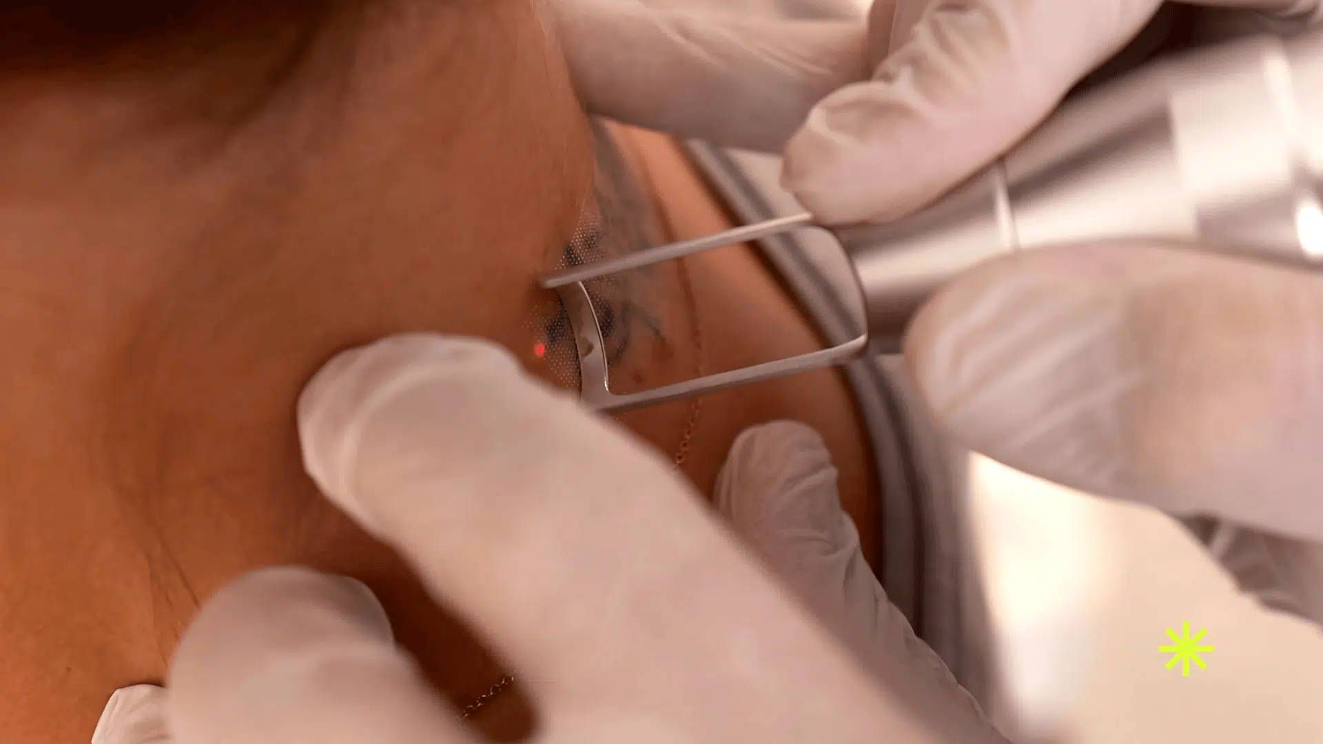 Laser-Tattoo-Removal-Before-and-After-Visible-Skin-Changes