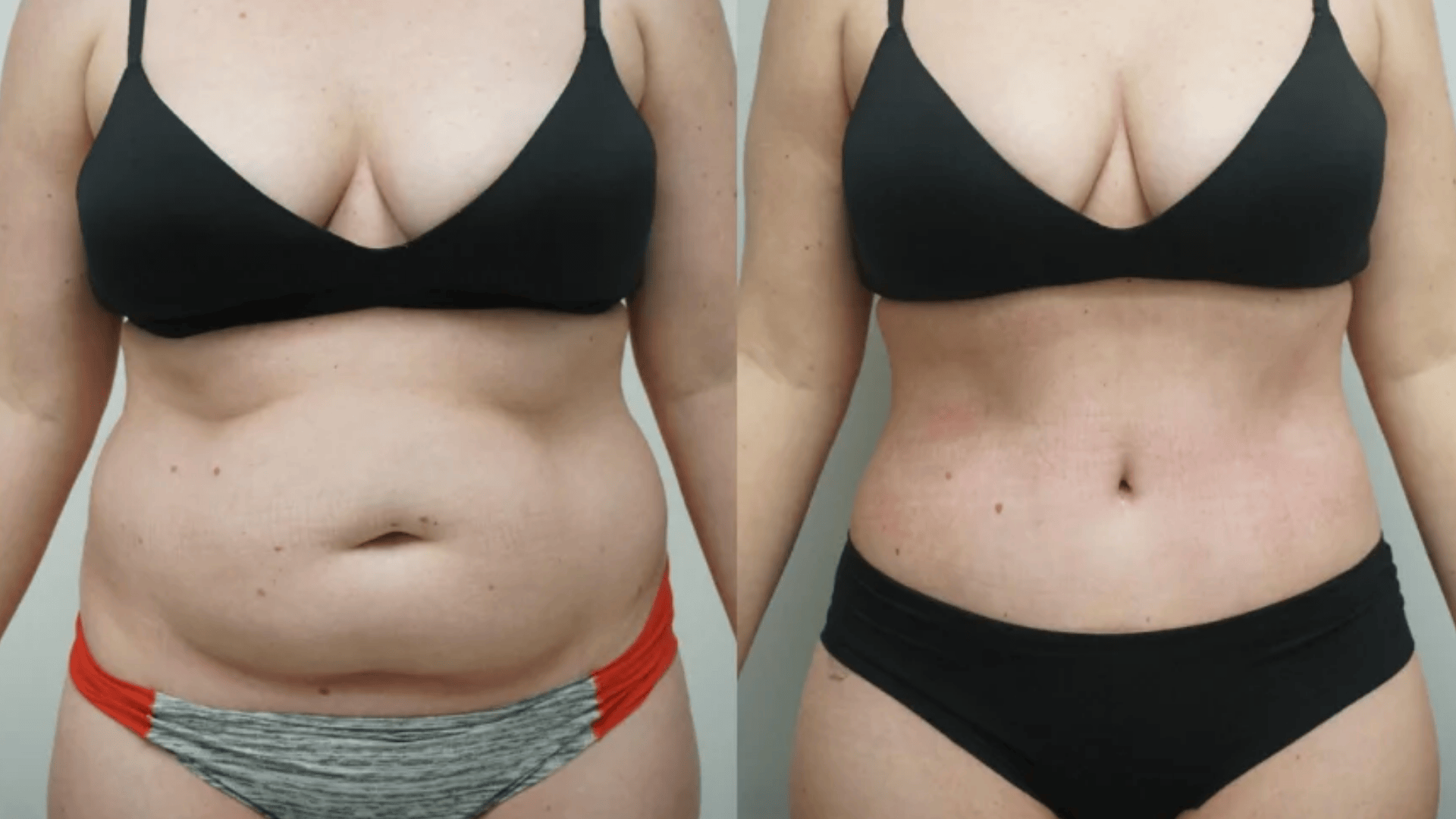 Liposuction