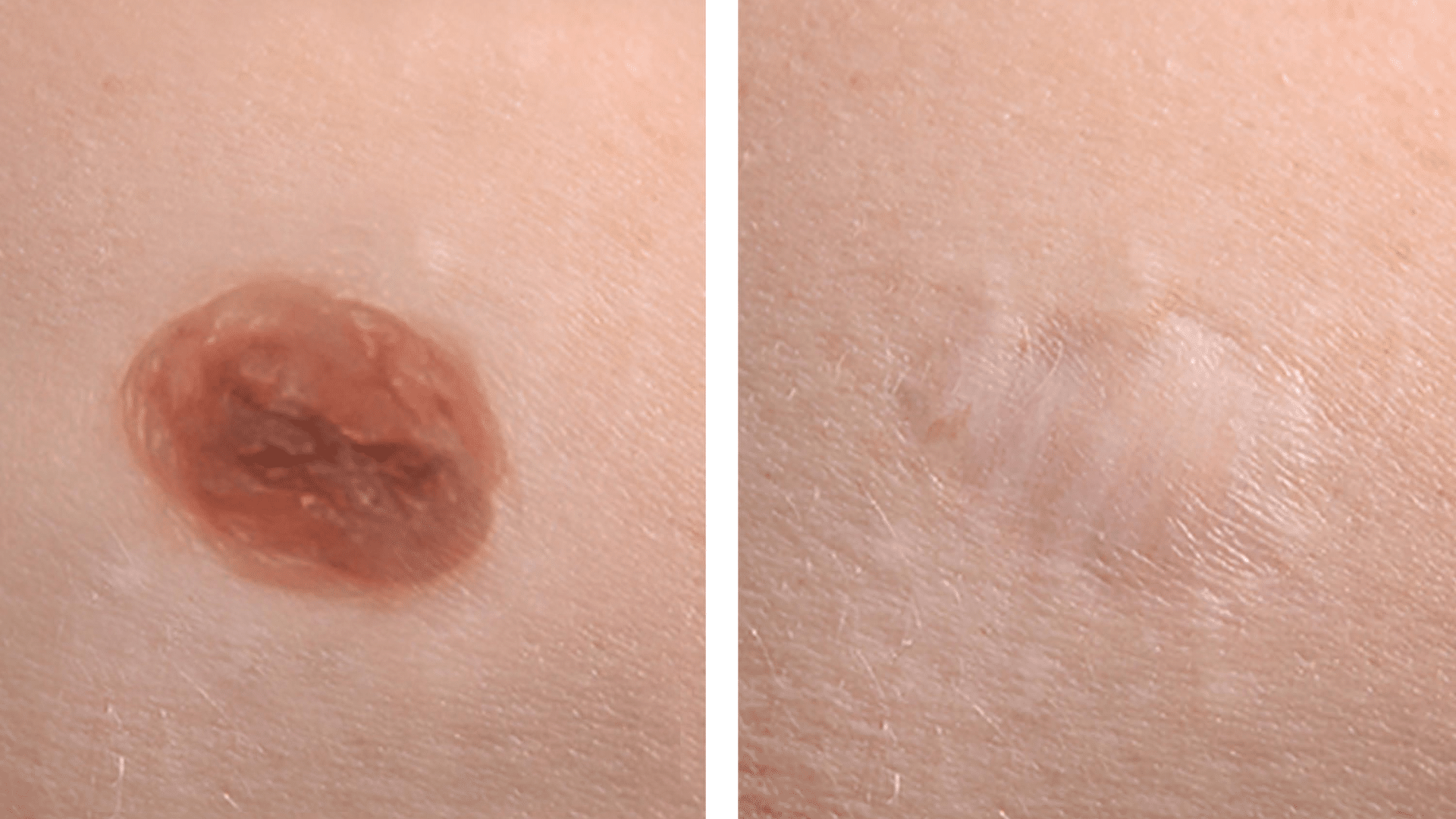 Mole Grows Back in the Scar