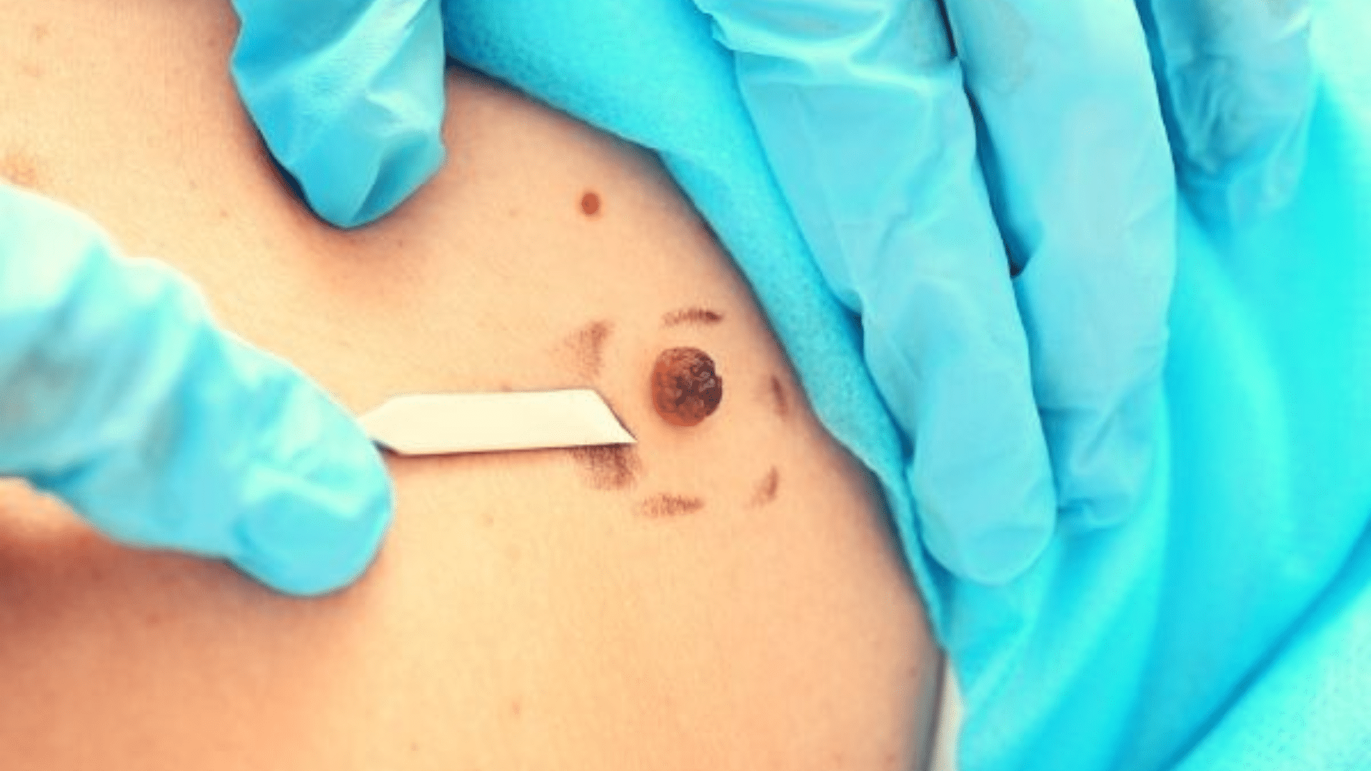 Mole Removal Healing Stages In Detail