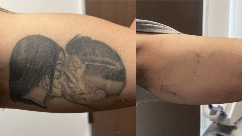 PicoWay Tattoo Removal- How It Works