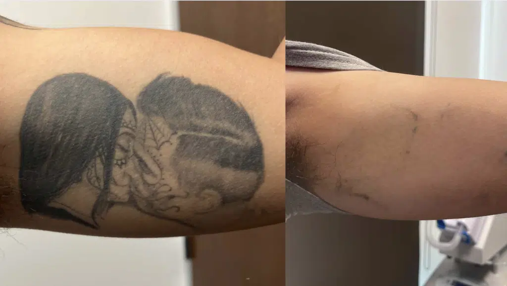 PicoWay Tattoo Removal- How It Works