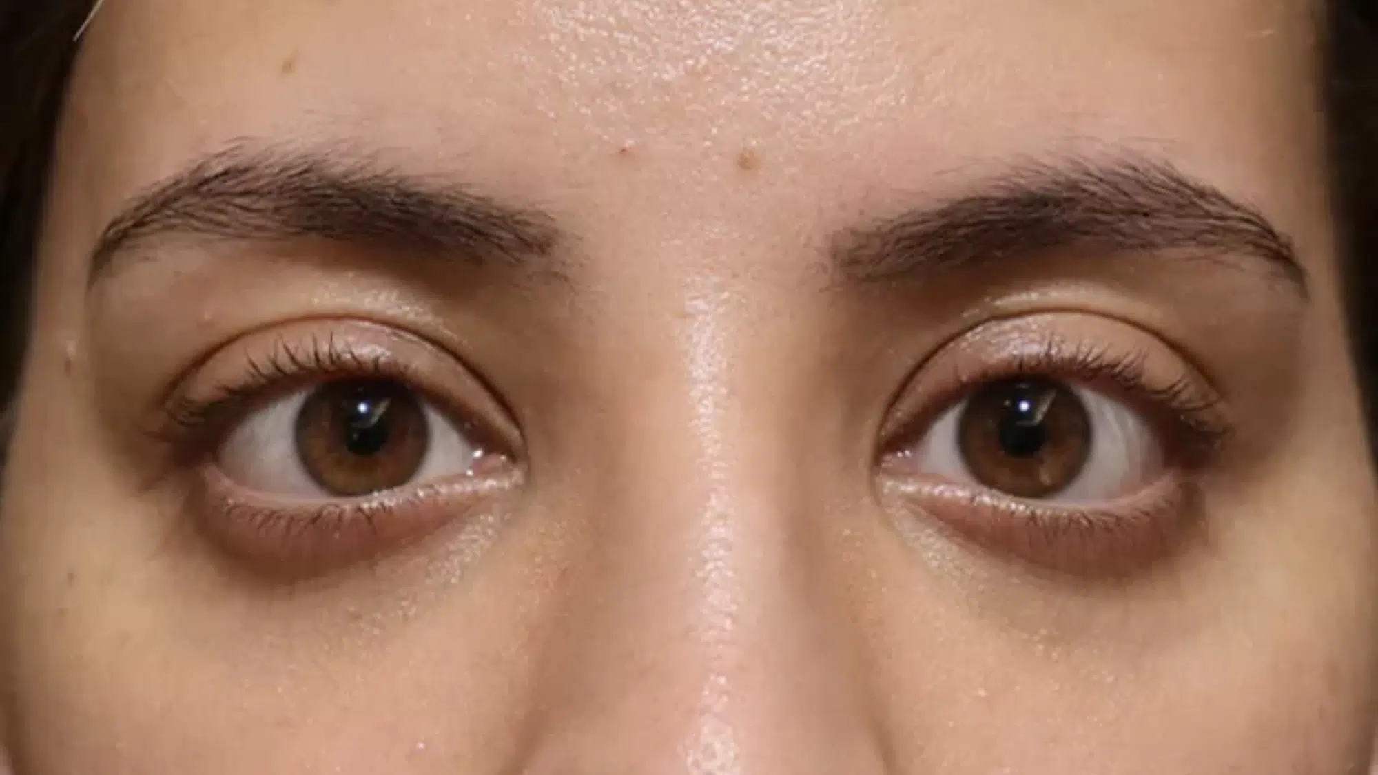 Protruding (Prominent) Eyes