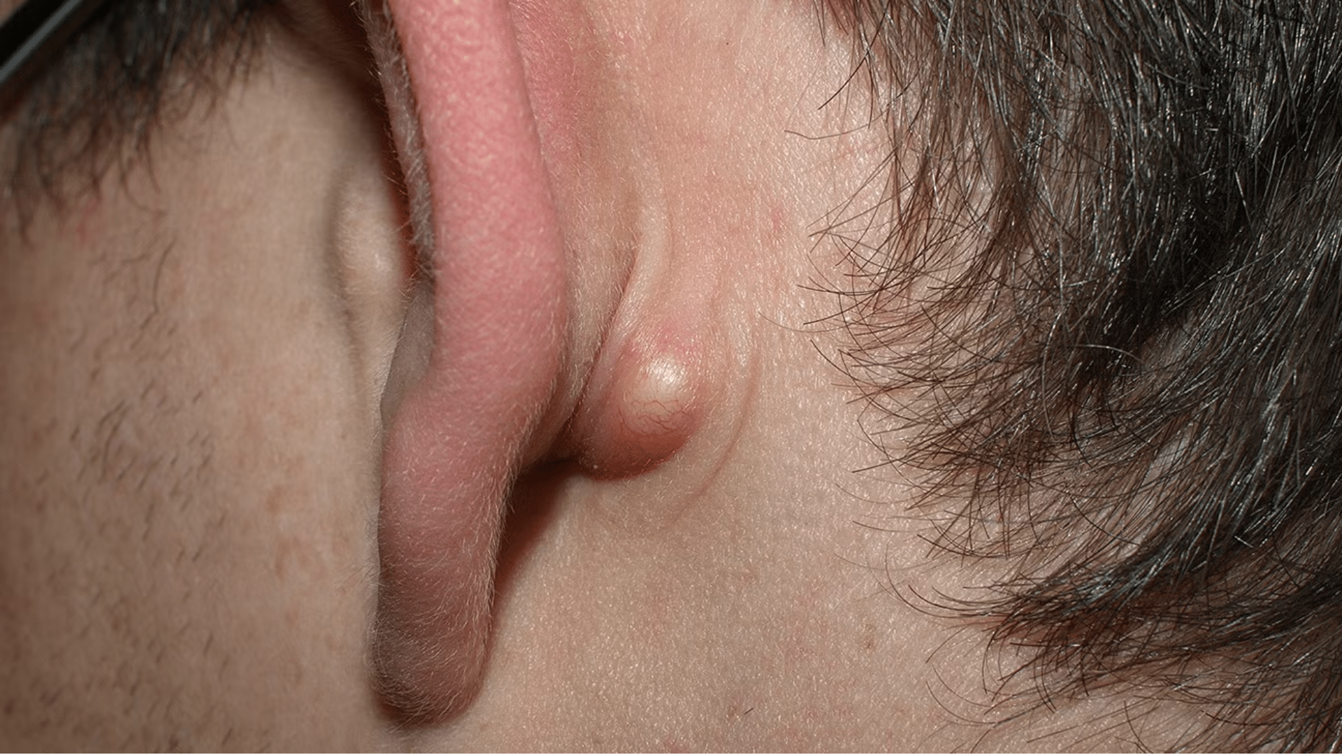 Sebaceous Cyst