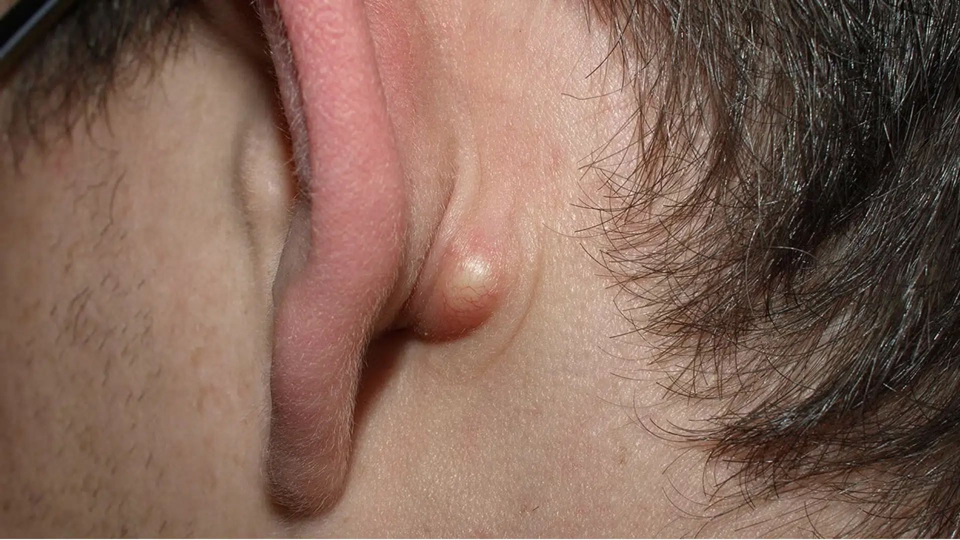 Sebaceous Cyst