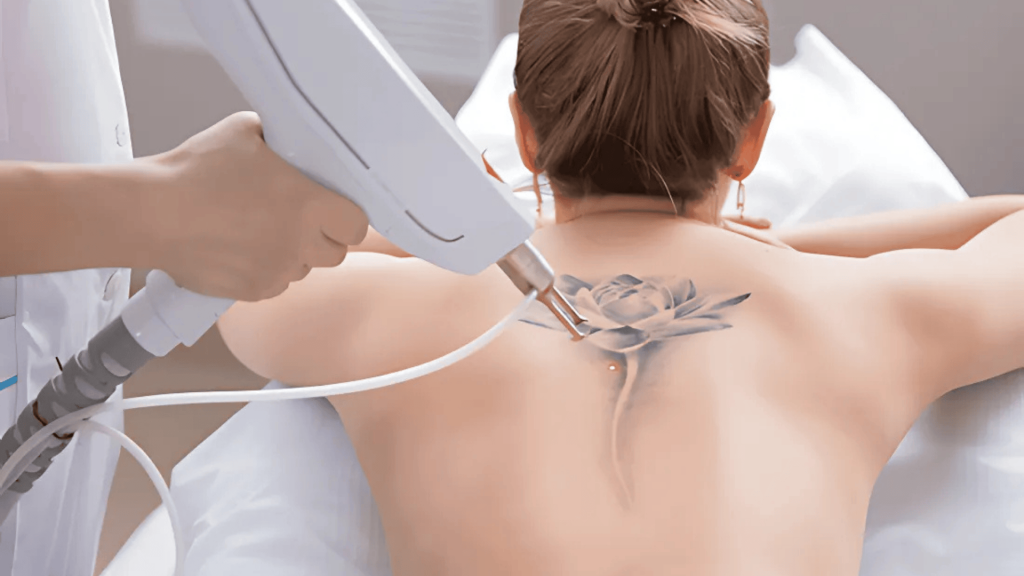 Skin After Tattoo Removal- Healing & Care Guide