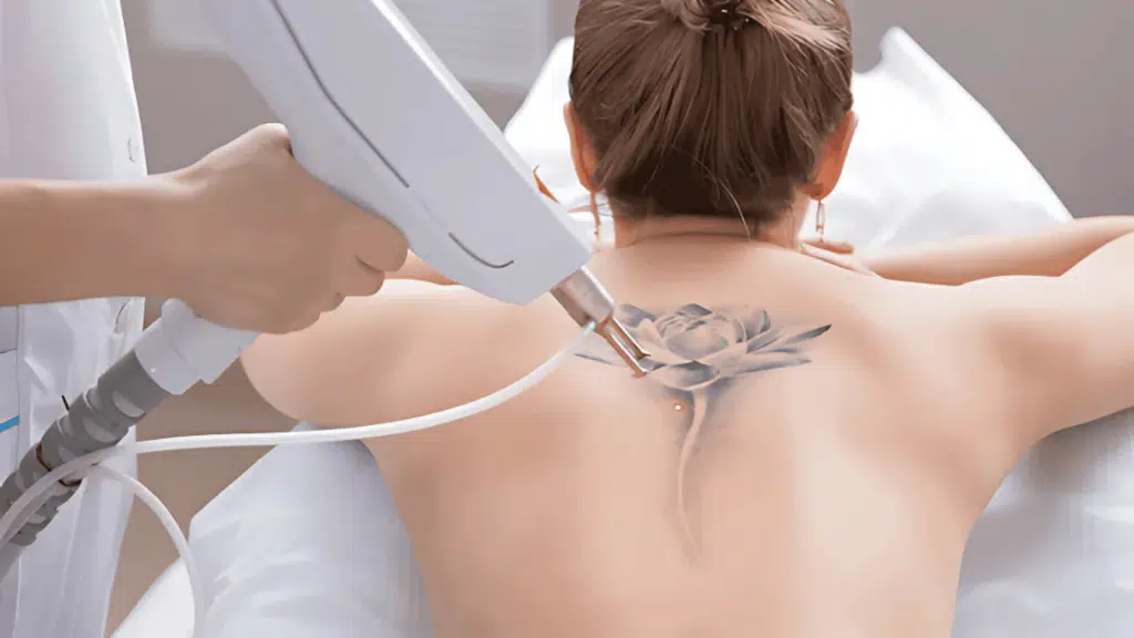 Skin After Tattoo Removal- Healing & Care Guide