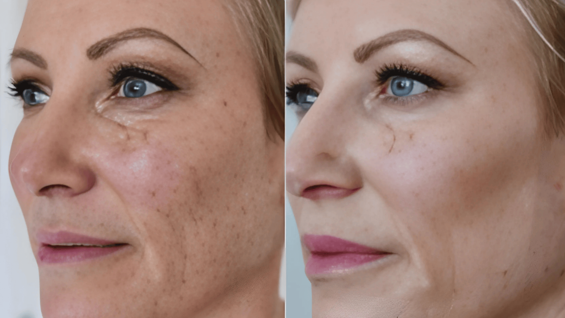 Skin-Concerns-HALO-Treatment-Can-Address