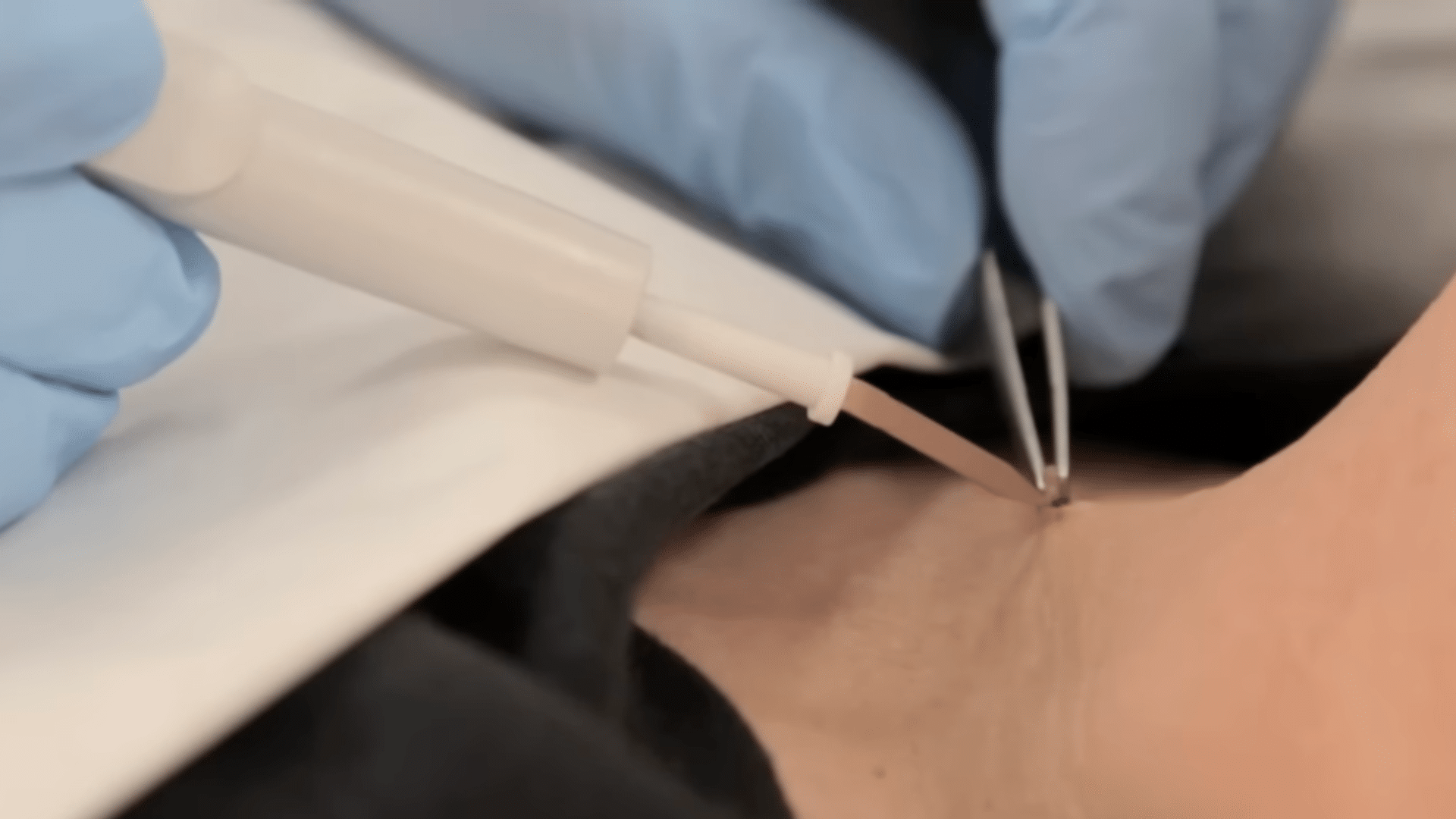 Step 2 Removing the Skin Tags