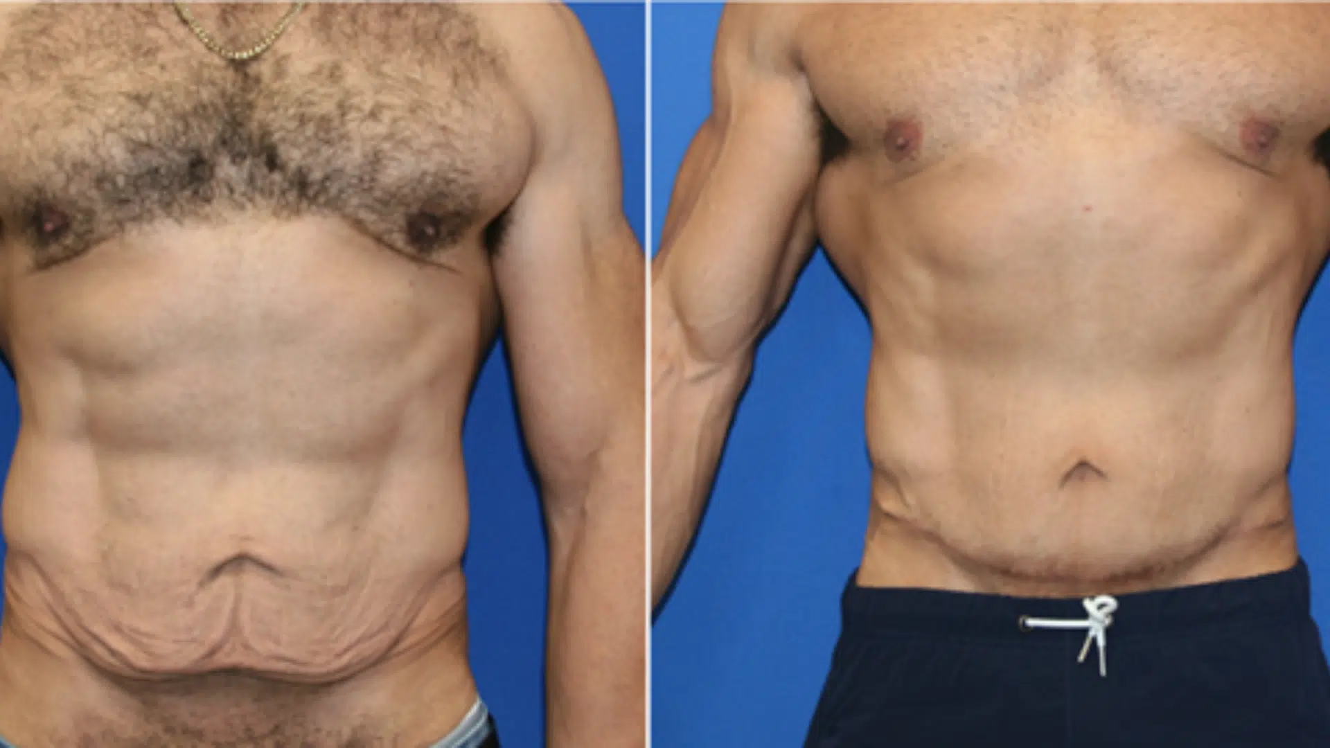 Tummy Tuck (Abdominoplasty)