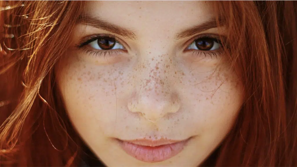 freckle treatments