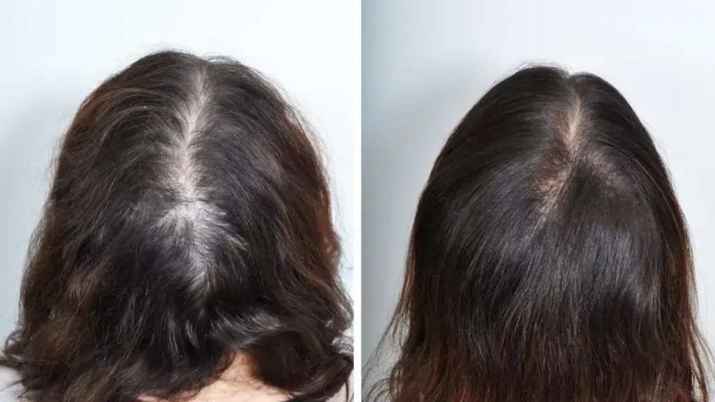 hair implants for women