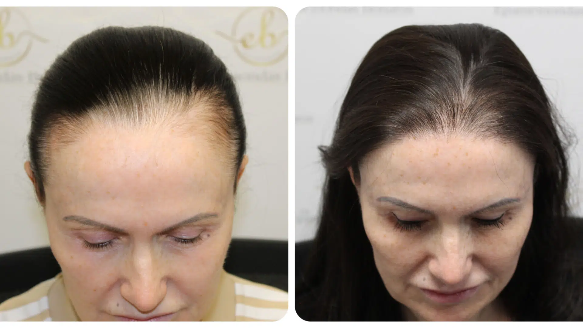 hairline restoration