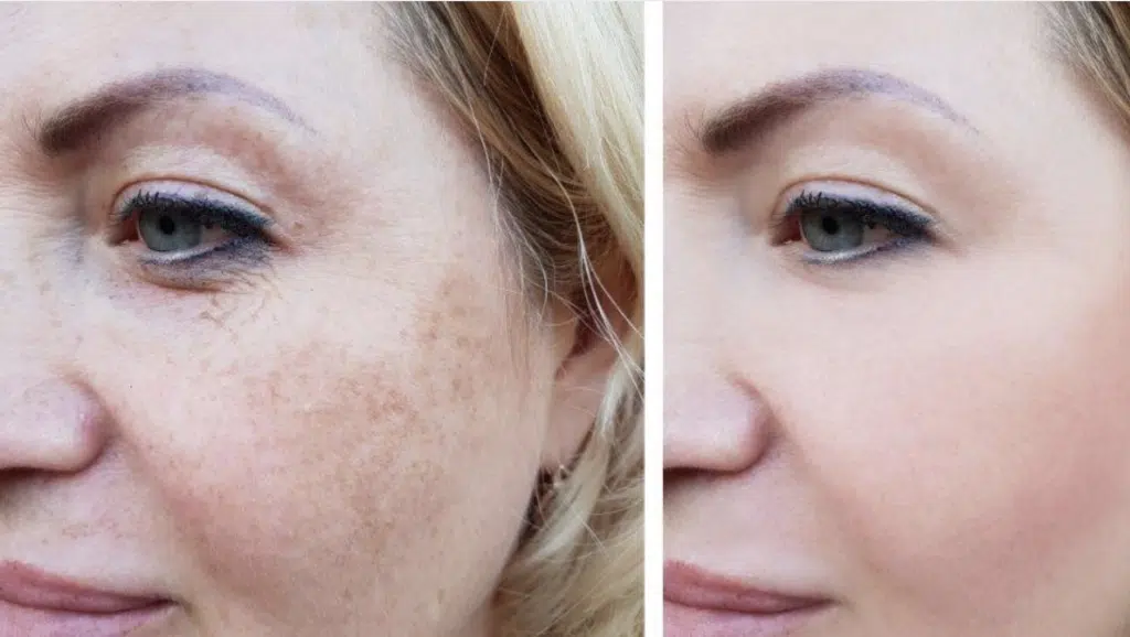 hyperpigmentation laser treatment