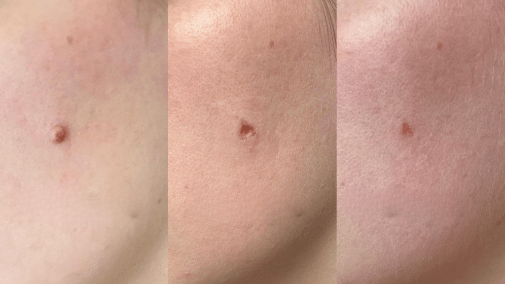 mole removal healing stages