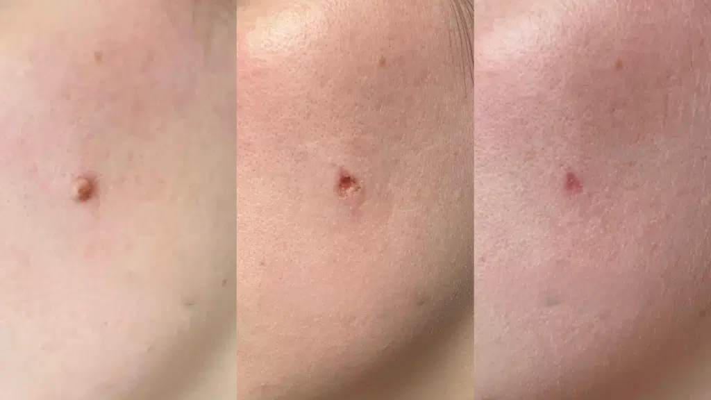 mole removal healing stages