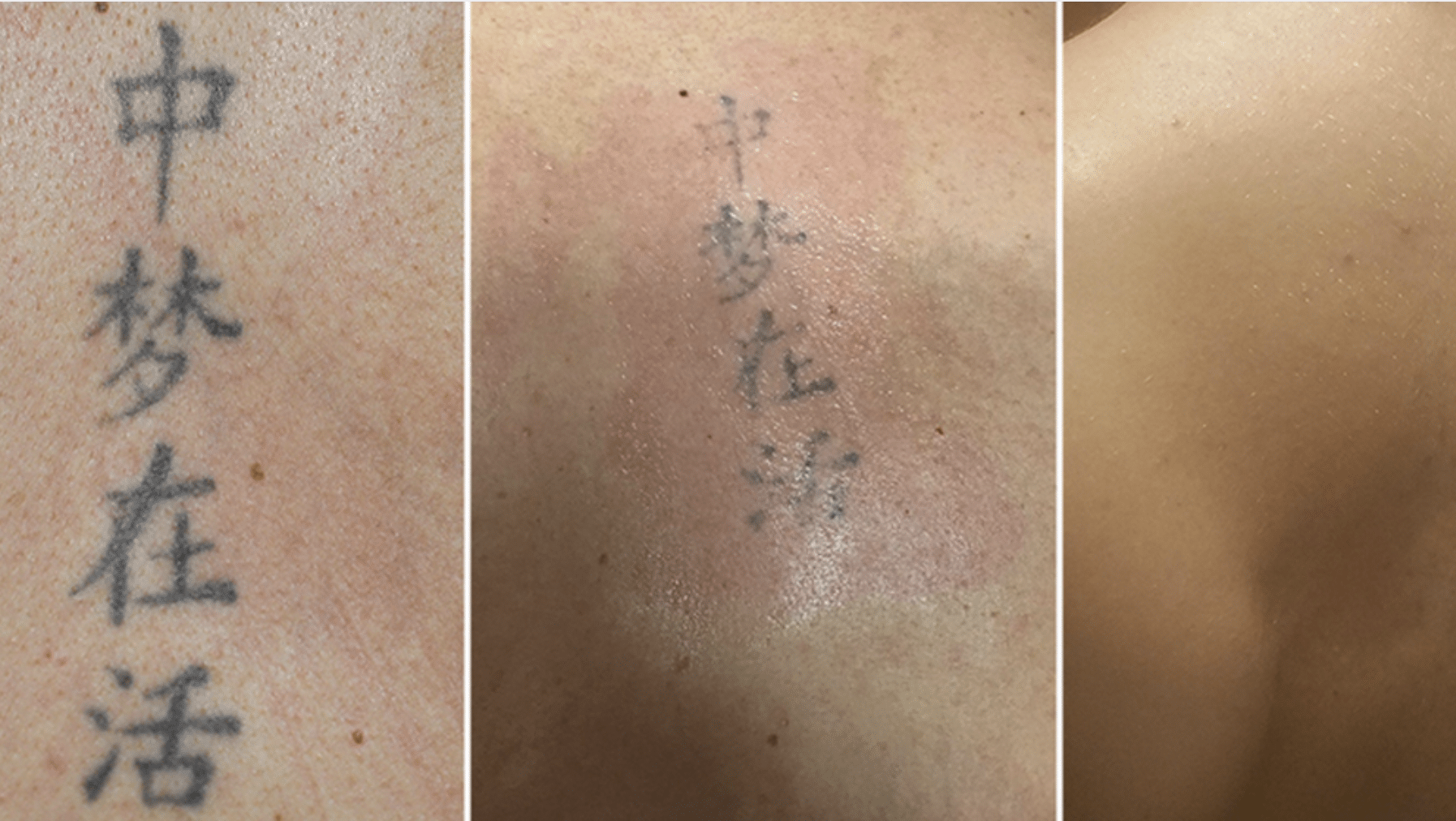 picoway tattoo removal step by step