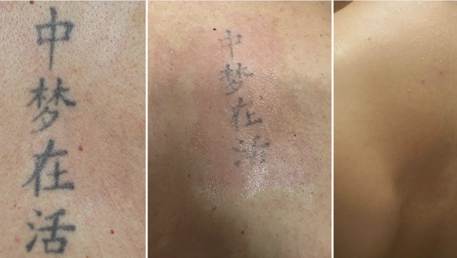 picoway tattoo removal step by step