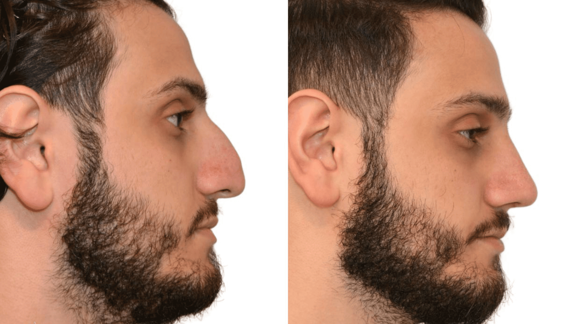rhinoplasty