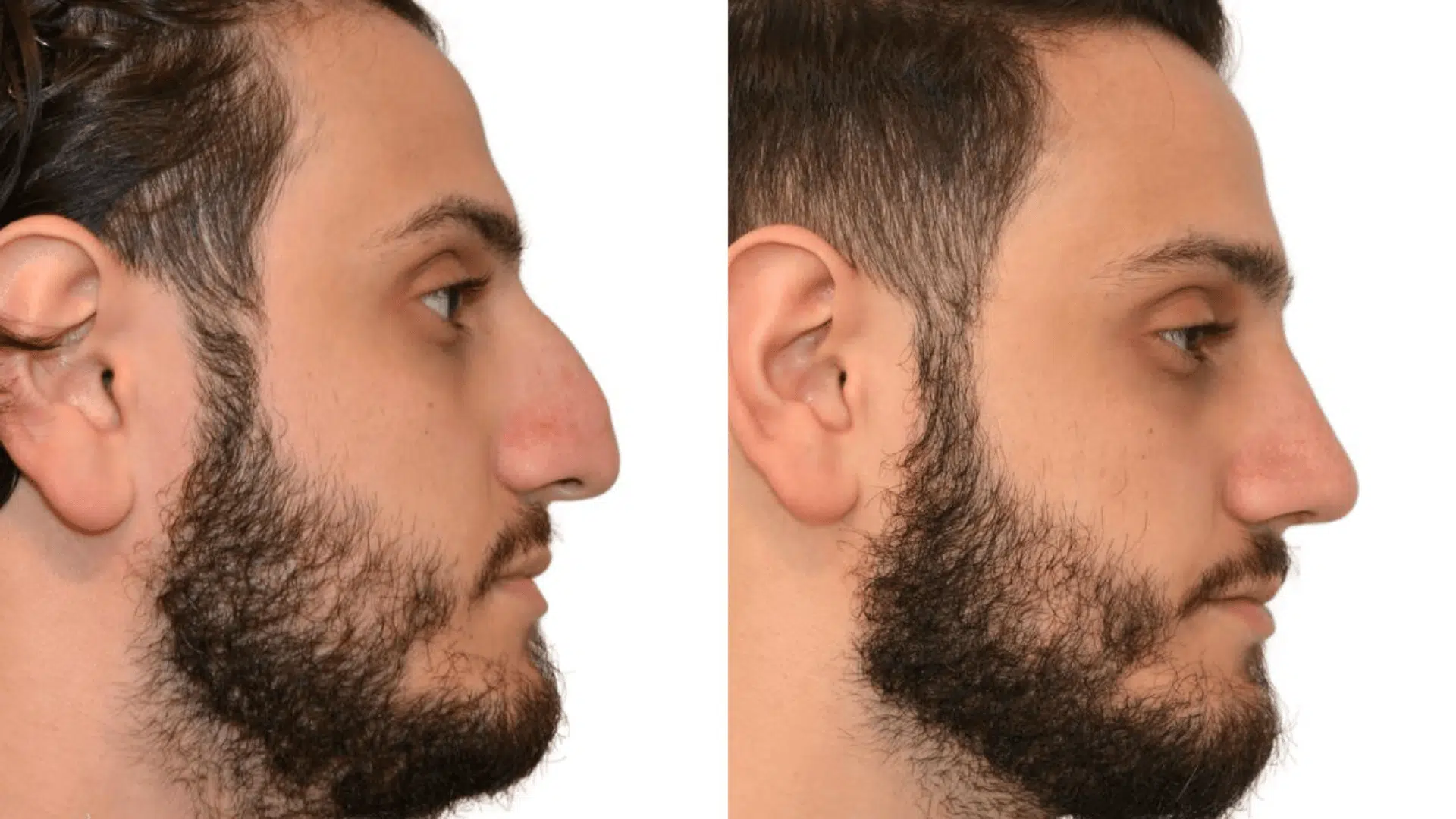 rhinoplasty