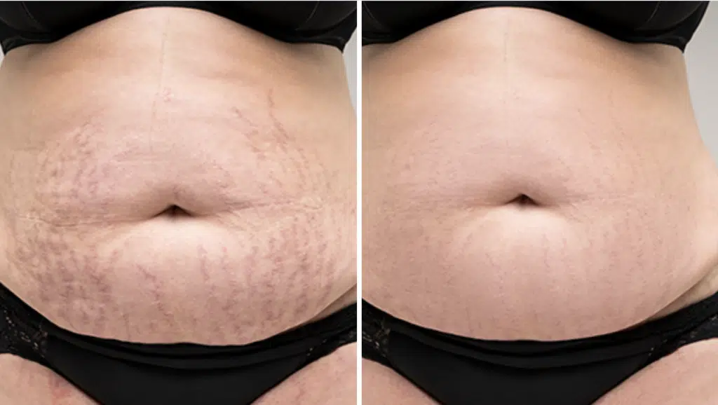 stretch mark removal laser