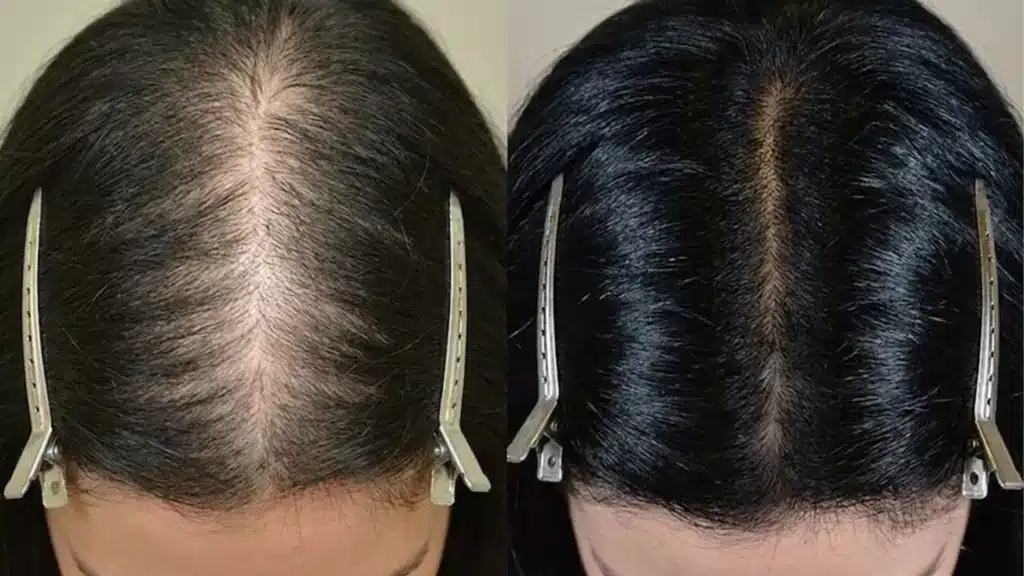 Before and after hair thinning improvement showing fuller scalp coverage and reduced part widening over time