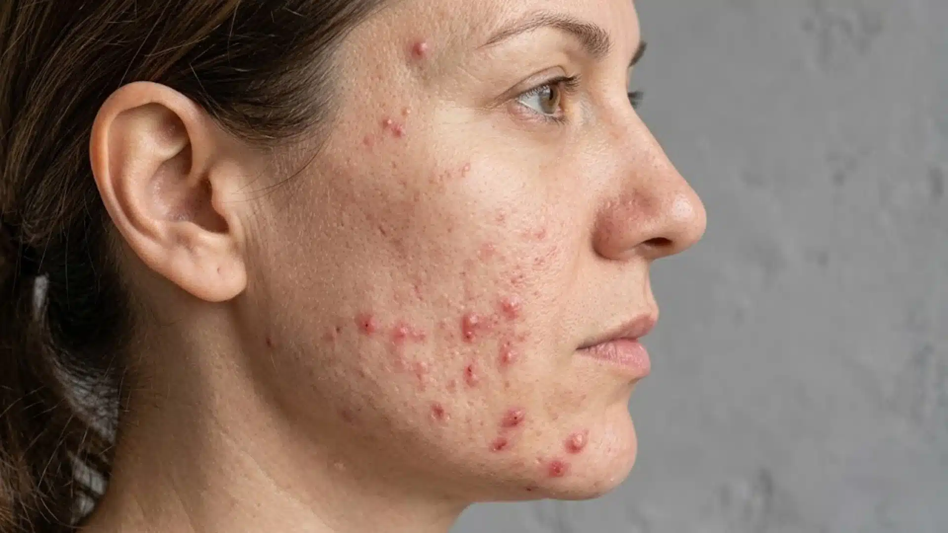 Close-up of a woman’s face with visible hormonal acne breakouts on cheeks and jawline, showing inflamed pimples and skin texture