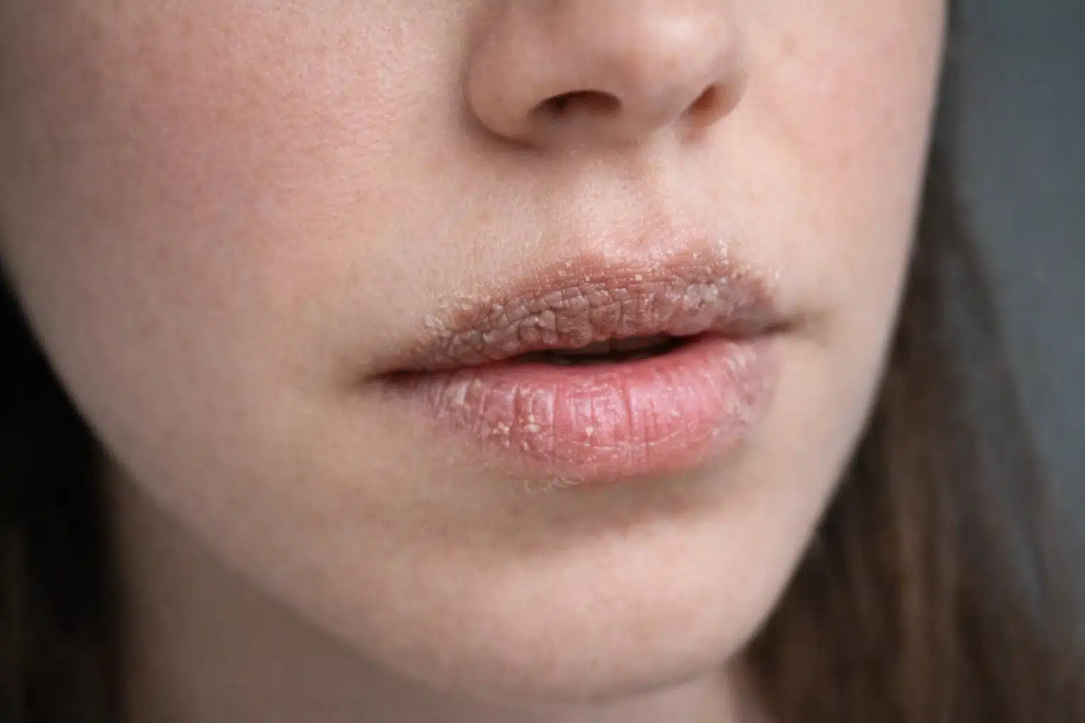 Close up of dry chapped lips with flaking skin showing conditions that can impact lip blush results and healing process