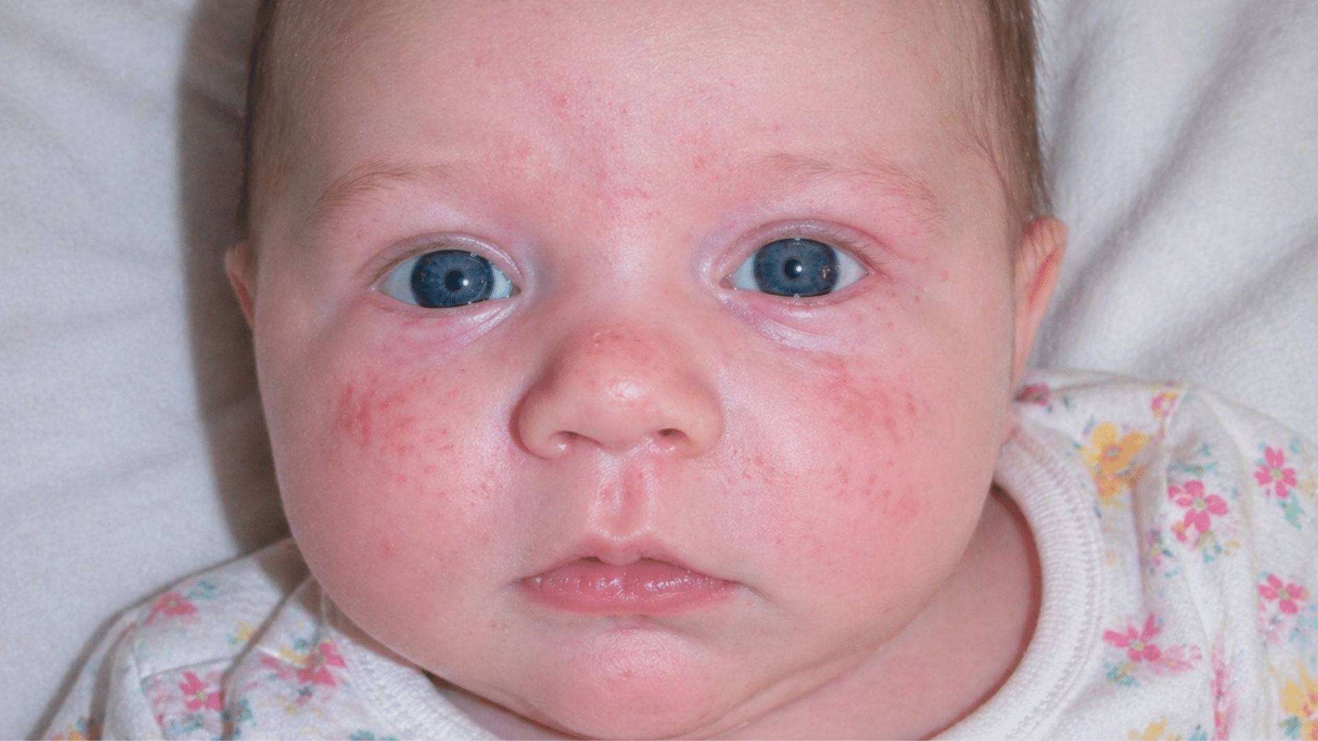 A close-up of a baby with blue eyes and a red, bumpy rash across their cheeks and forehead.