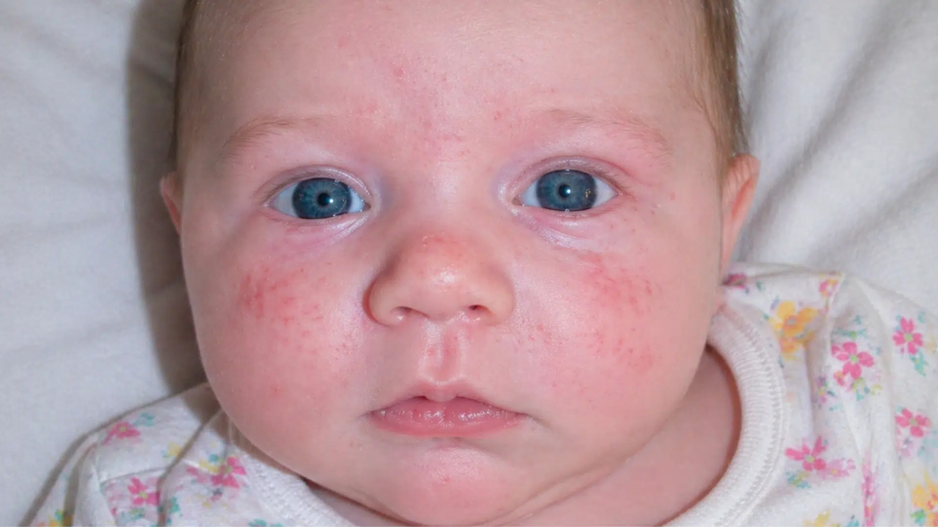 A close-up of a baby with blue eyes and a red, bumpy rash across their cheeks and forehead.