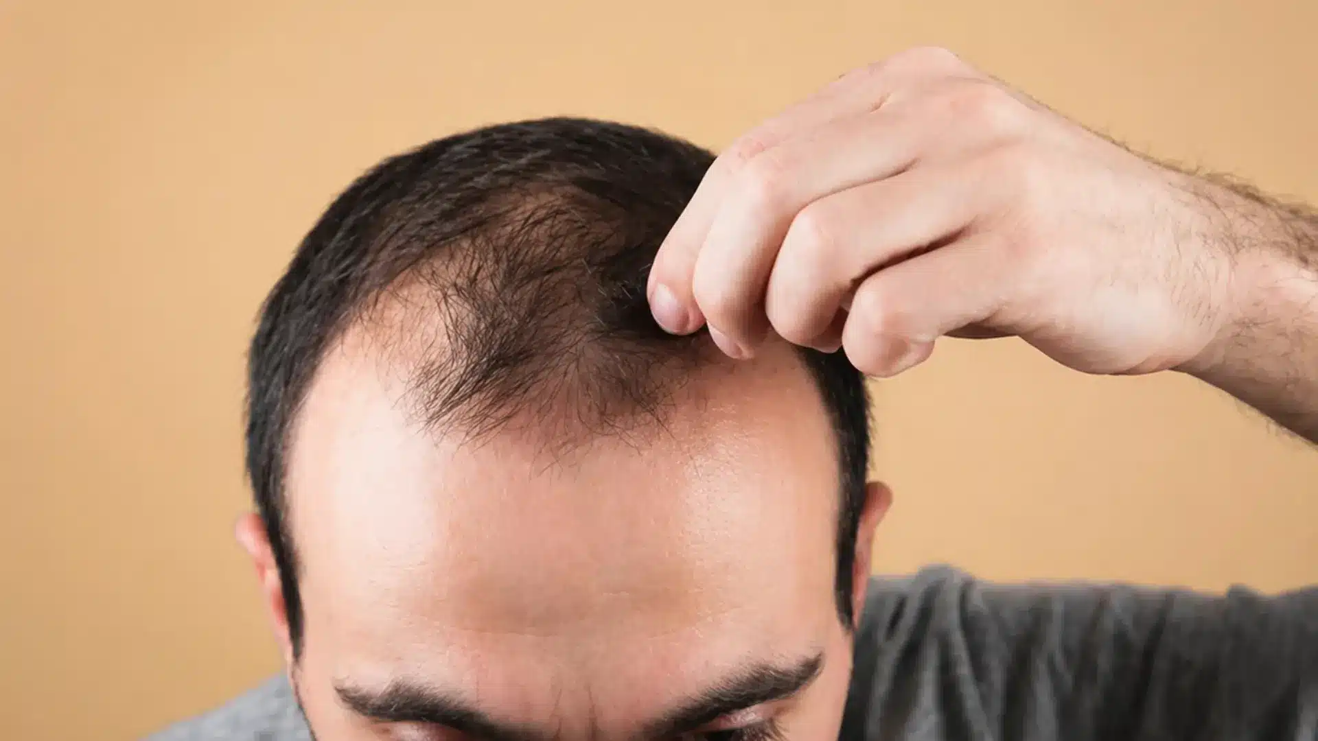 A man looking down while touching his thinning hair and receding hairline against a tan background.webp.