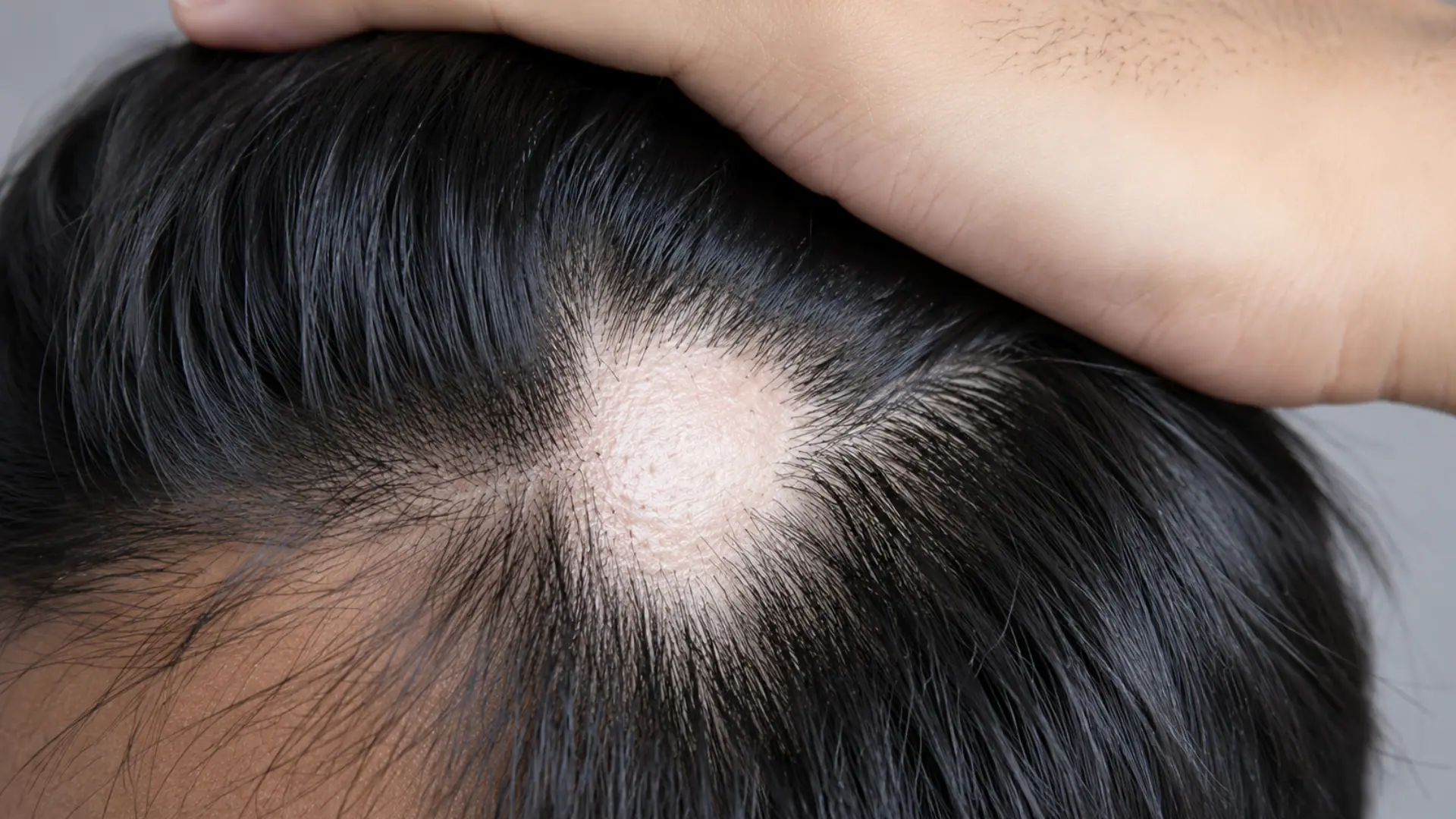 A person holds back their dark hair to reveal a smooth, round, coin-sized bald patch on their scalp