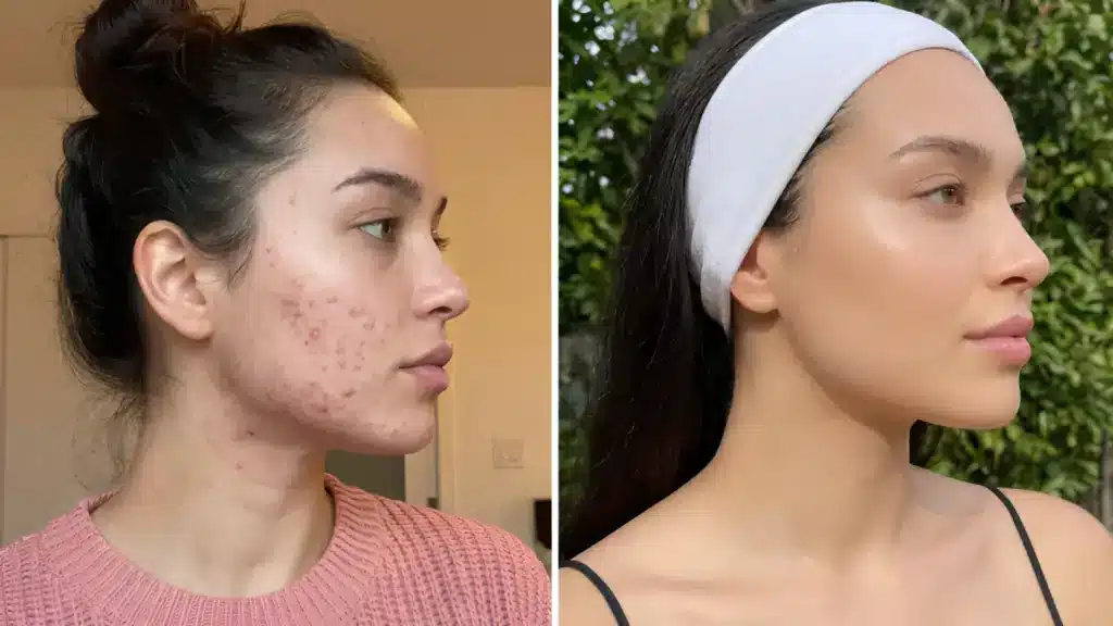 Before and after clear skin transformation showing acne prone skin and healthy glowing complexion outdoors