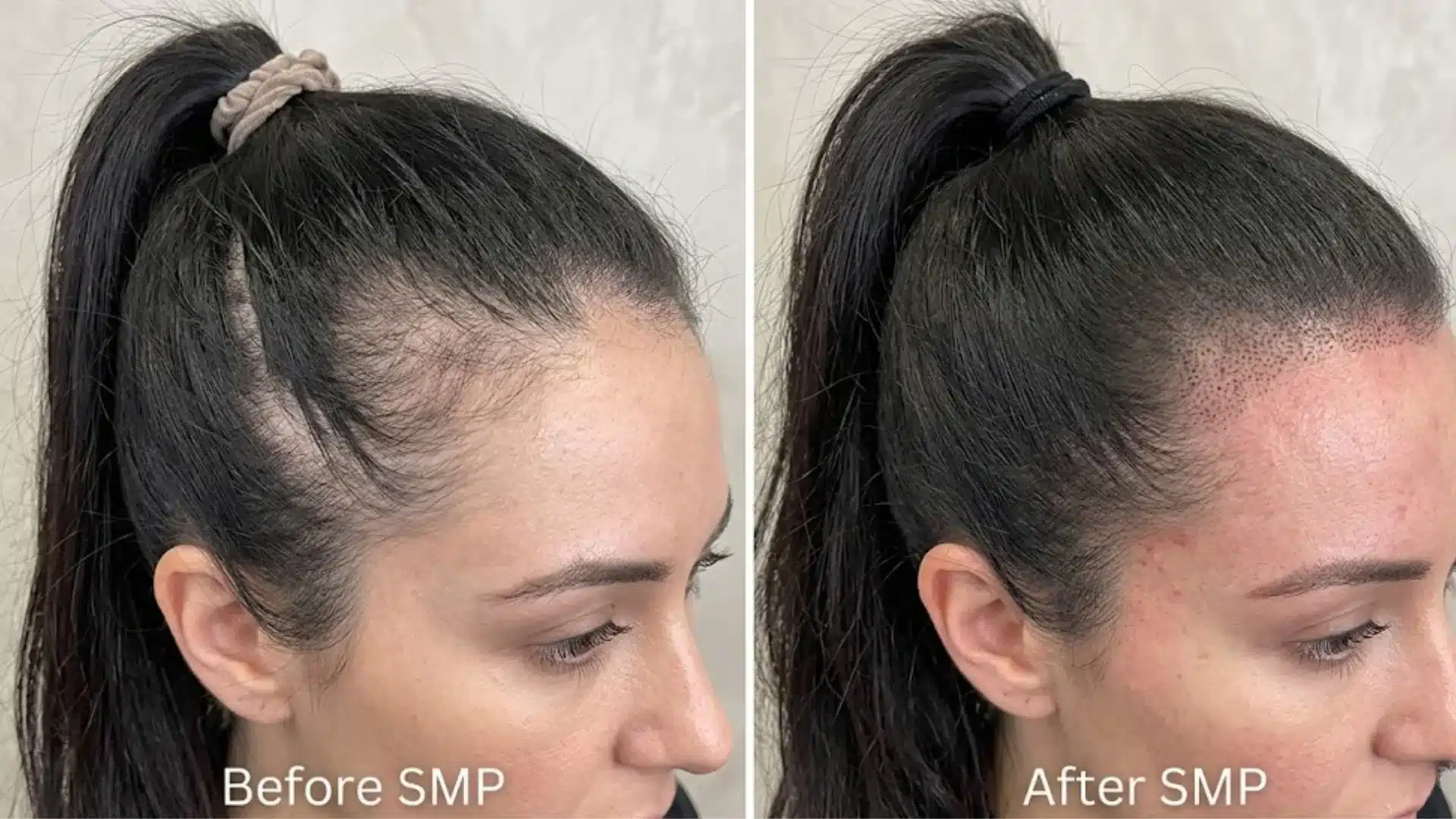 Before and after SMP for women showing a fuller hairline and reduced visible scalp near the temples