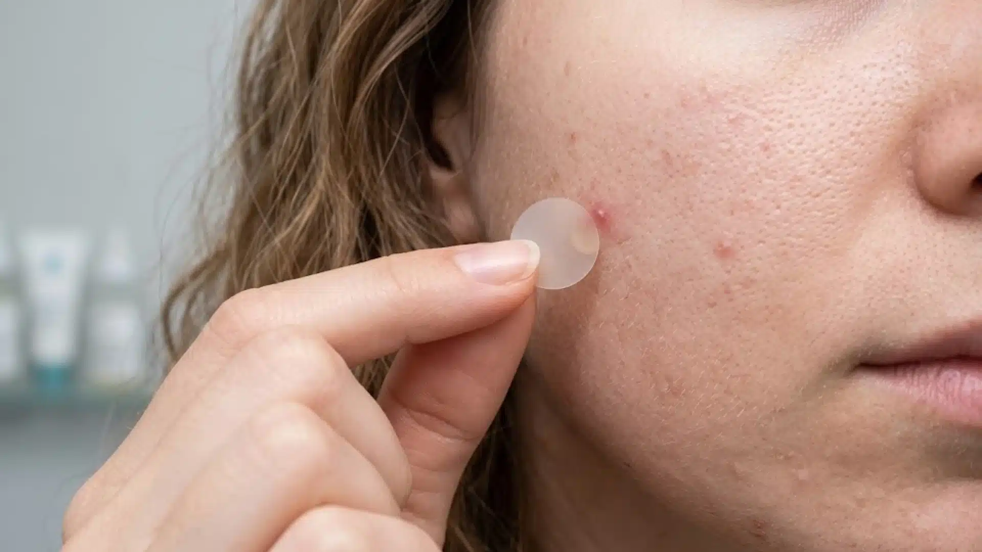 Close-up of a hydrocolloid pimple patch being applied to a red acne spot on textured facial skin