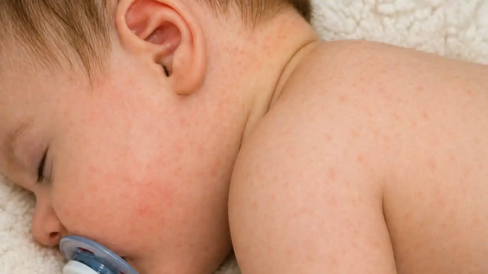 Close-up of a sleeping baby with a red, bumpy heat rash or eczema on their cheek, neck, and shoulder