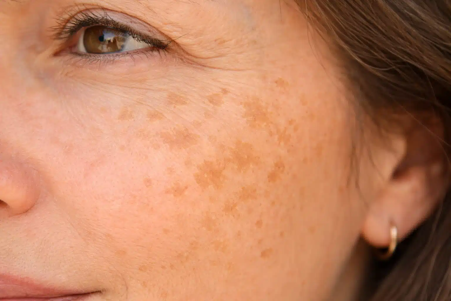 Close up of cheek with sunspots and age spots showing uneven pigmentation and small brown patches on mature skin