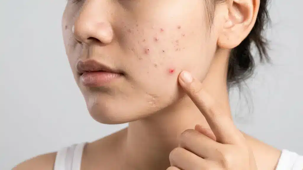 Close-up of facial acne and red pimples on skin with finger pointing at an inflamed breakout spot