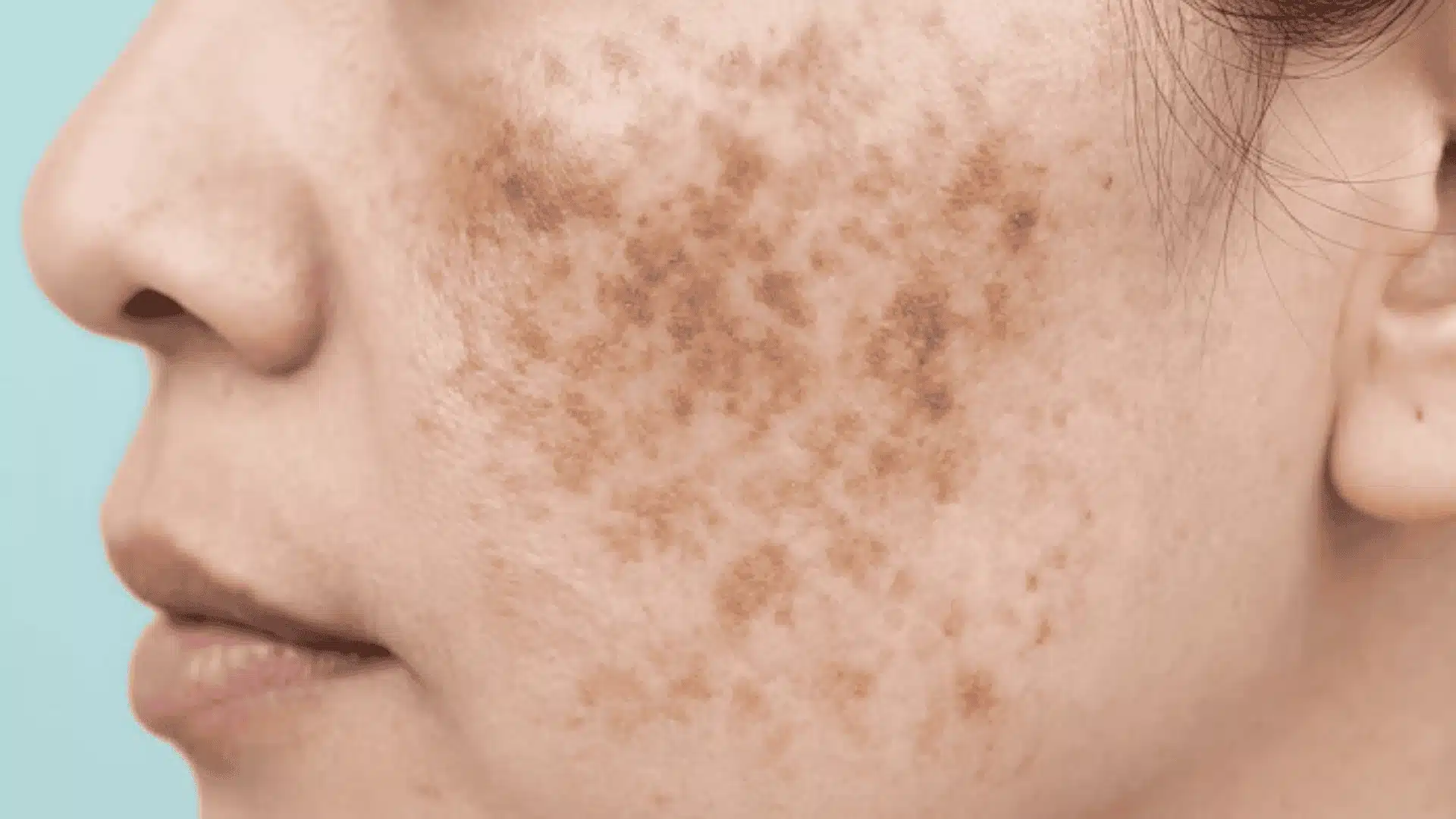 Close-up of facial skin with deep dermal hyperpigmentation and uneven dark spots showing persistent pigmentation layers