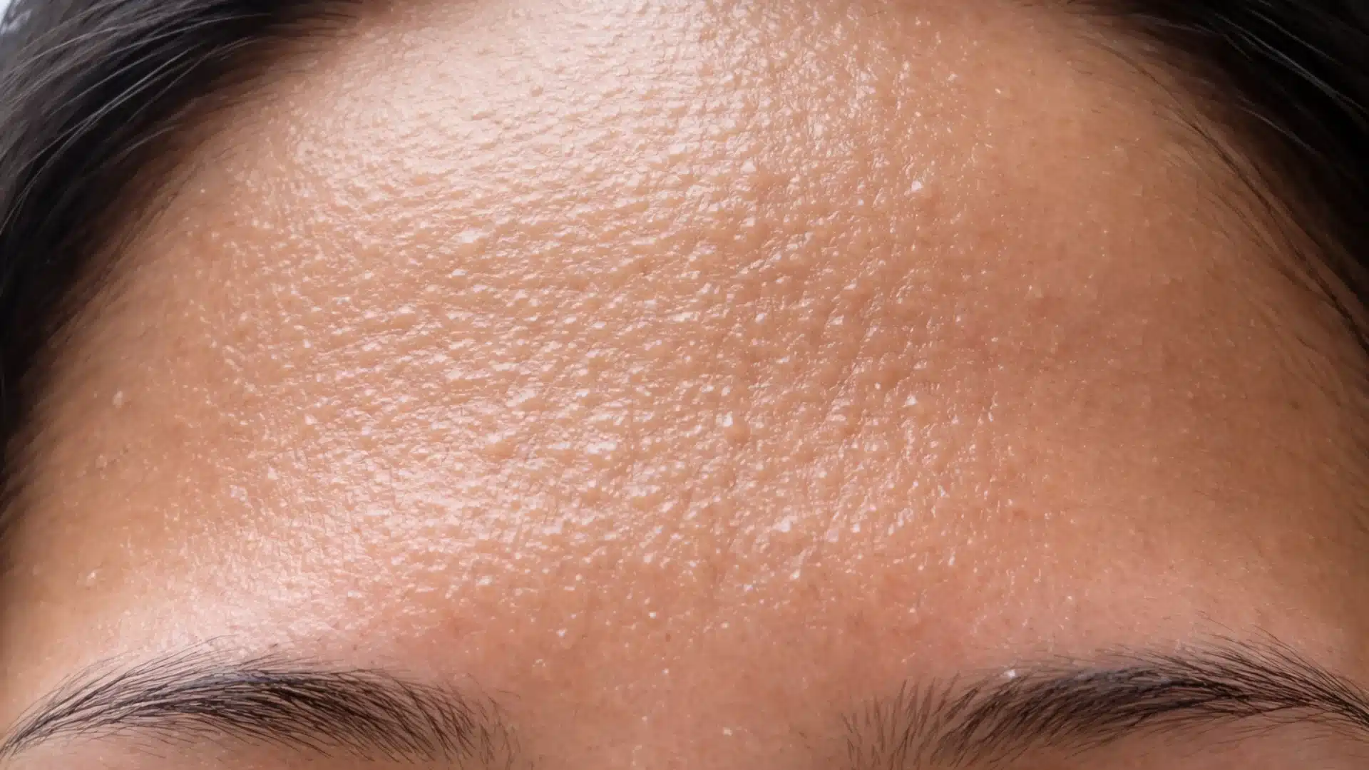 Close-up of oily forehead with small bumps and uneven skin texture, showing clogged pores and mild acne across the T-zone area