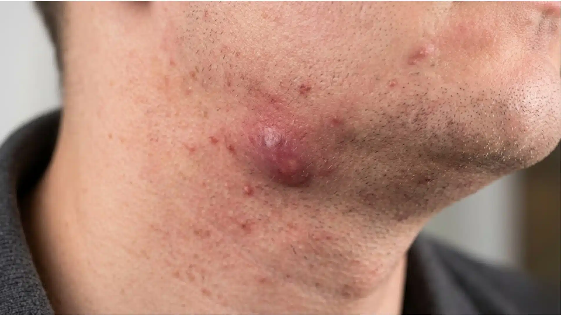 Close-up of painful cystic acne on jawline and chin area, showing inflamed red bumps typical of hormonal acne pattern