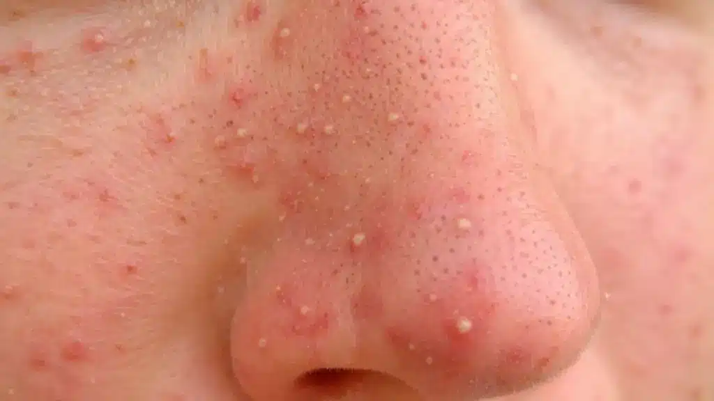 Close-up of pimples on the tip of the nose in natural light